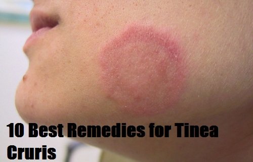 Remedies for Tinea Cruris