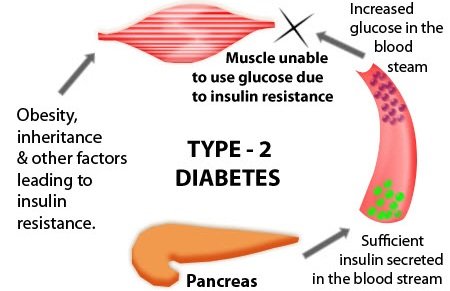 type-2-diabetes