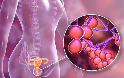 Yeast Infections